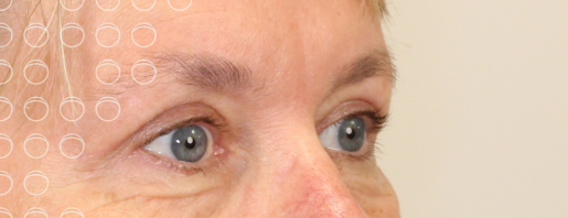 bovenooglidcorrectie-resultaat-Yvonne-na
